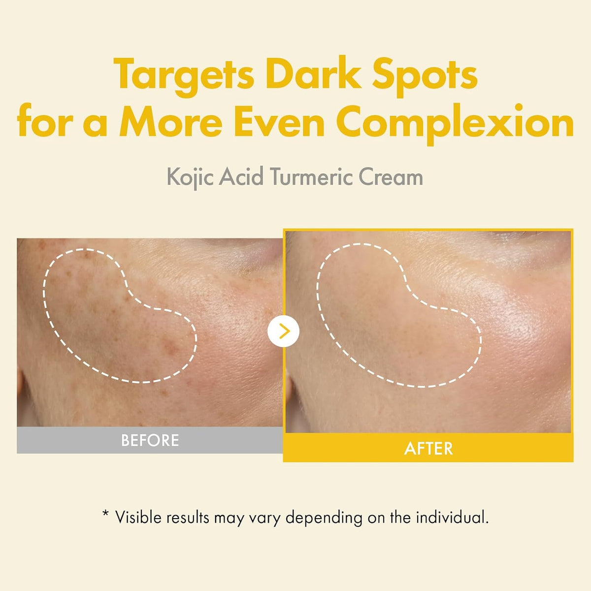 Kojic Acid Turmeric Cream for Dark Spots & Hyperpigmentation